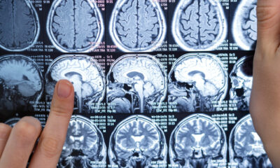 Neurocirurgião esclarece dúvidas sobre tumor cerebral