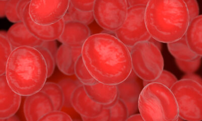 Novo tratamento para mieloma múltiplo é aprovado pela Anvisa